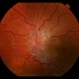 Papilledema Papilledema